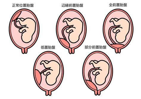 胎盤形成出血|胎盤の重要な役割と前置胎盤などのトラブル